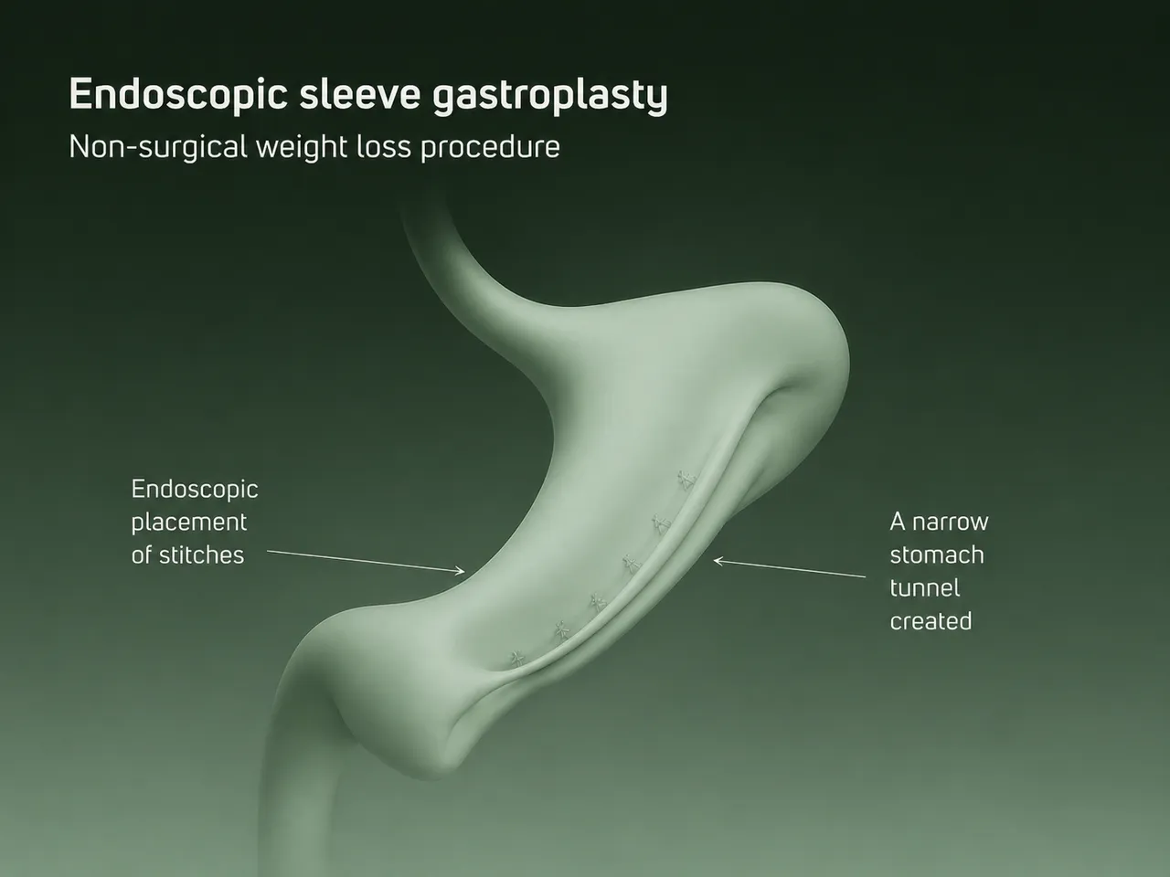Captura de pantalla relacionada con liposuction vs bariatric surgery
