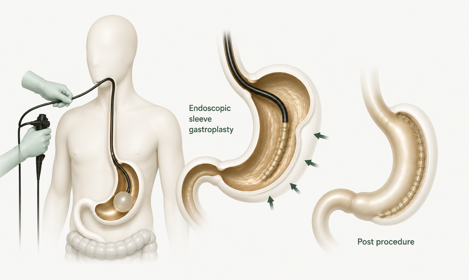 Endoscopic sleeve gastroplasty showing sutures reducing stomach size without surgery