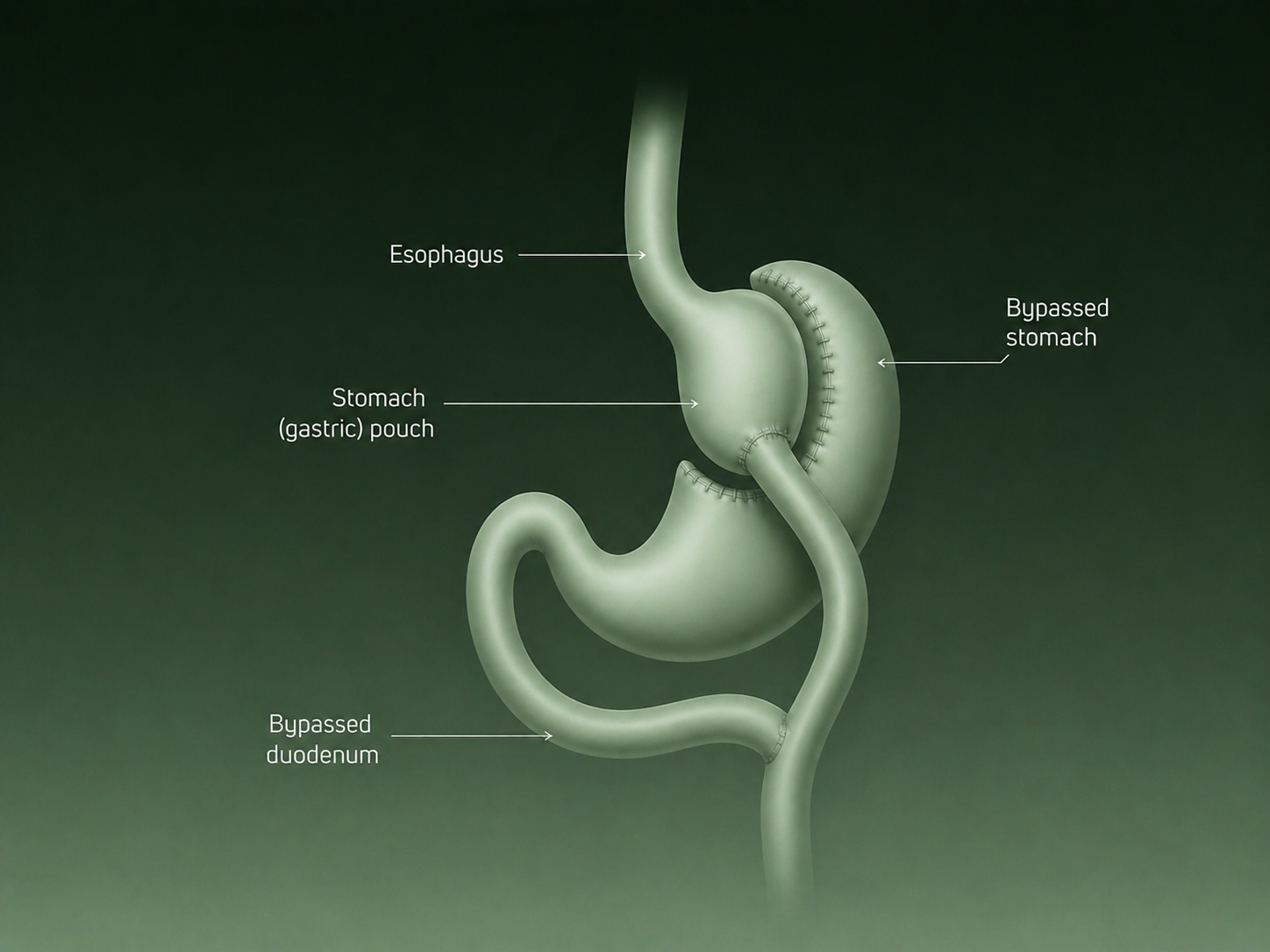 Illustration of Roux-en-Y gastric bypass showing a small stomach pouch and rerouted small intestine.