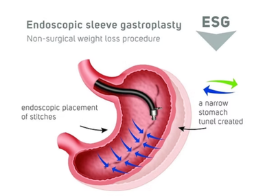 Endoscopic sleeve gastroplasty diagram showing sutures creating a smaller stomach for weight loss