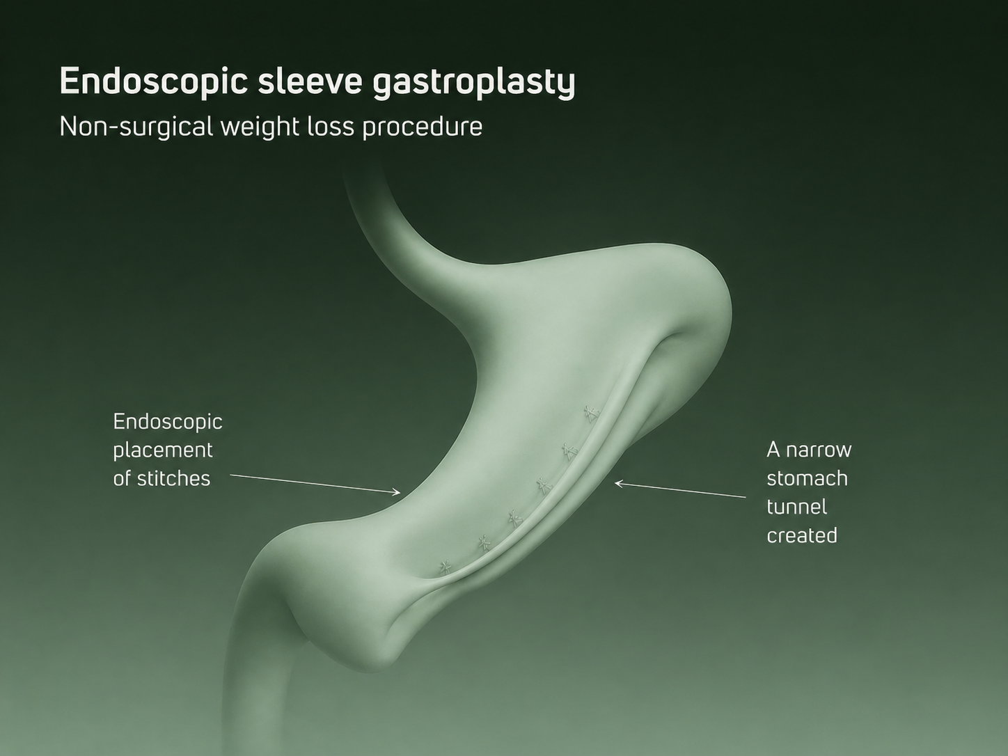 Endoscopic sleeve gastroplasty diagram showing sutures creating a smaller stomach for weight loss