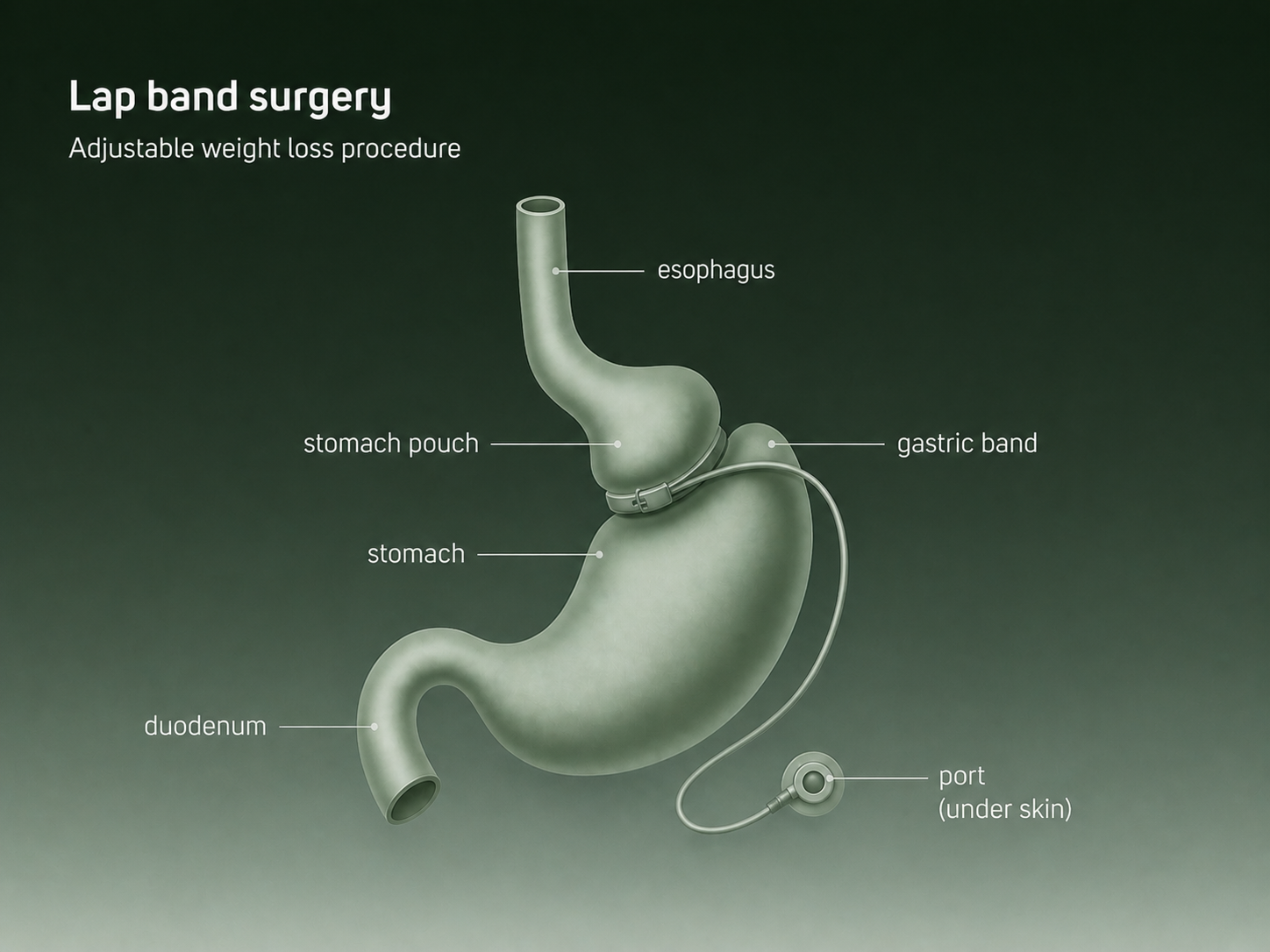 Diagram of lap band surgery showing an adjustable band around the upper stomach creating a small pouch.