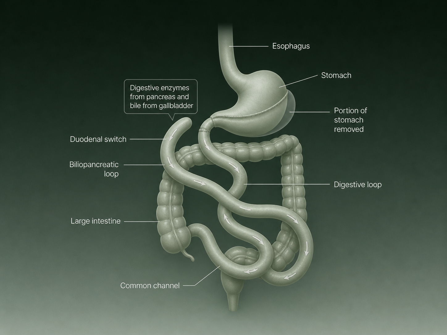 ## Medical diagram of duodenal switch surgery showing stomach sleeve and rerouted small intestine pathways.
