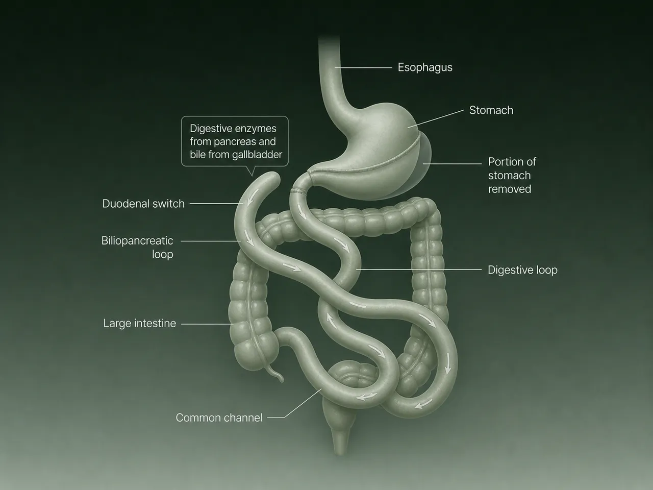El switch duodenal combina una manga gástrica con una reconfiguración intestinal, separando las asas digestiva y biliopancreática para maximizar tanto la restricción alimentaria como la malabsorción de calorías.