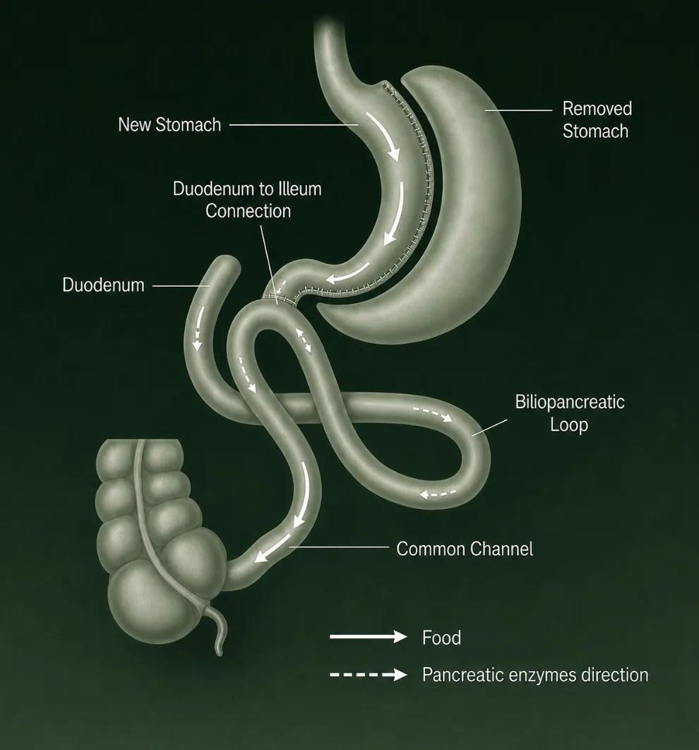 Diagrama de la cirugía de switch duodenal que muestra las vías de los alimentos y de las enzimas pancreáticas a través del nuevo estómago, el duodeno, el asa biliopancreática y el canal común.