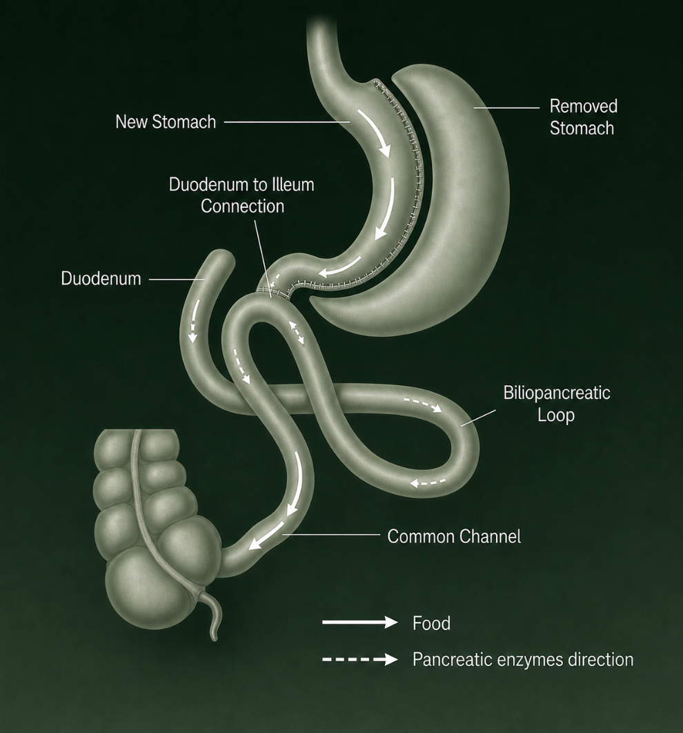 Diagram of duodenal switch surgery showing food and pancreatic enzyme pathways through the new stomach, duodenum, biliopancreatic loop, and common channel.
