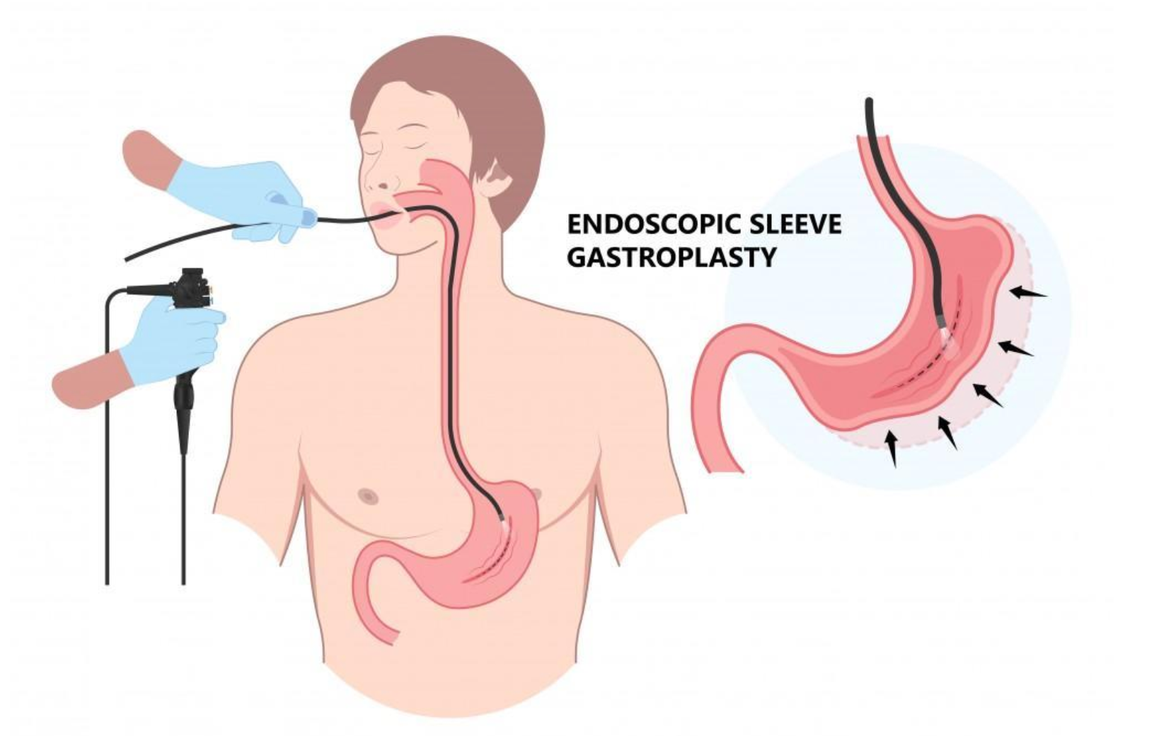 Diagram of the Endoscopic Sleeve Gastroplasty (ESG) procedure showing an endoscope inserted through the patient's mouth and the resulting sleeved stomach with internal sutures