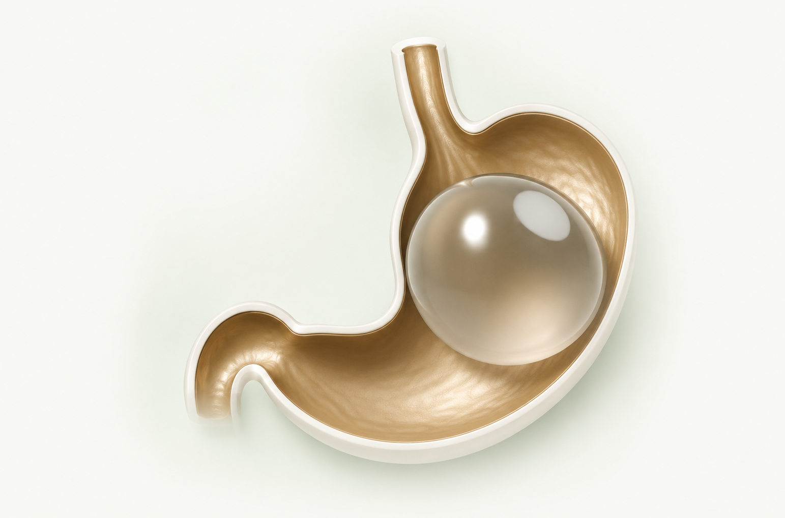 Gastric balloon inside stomach helping reduce food intake and increase fullness