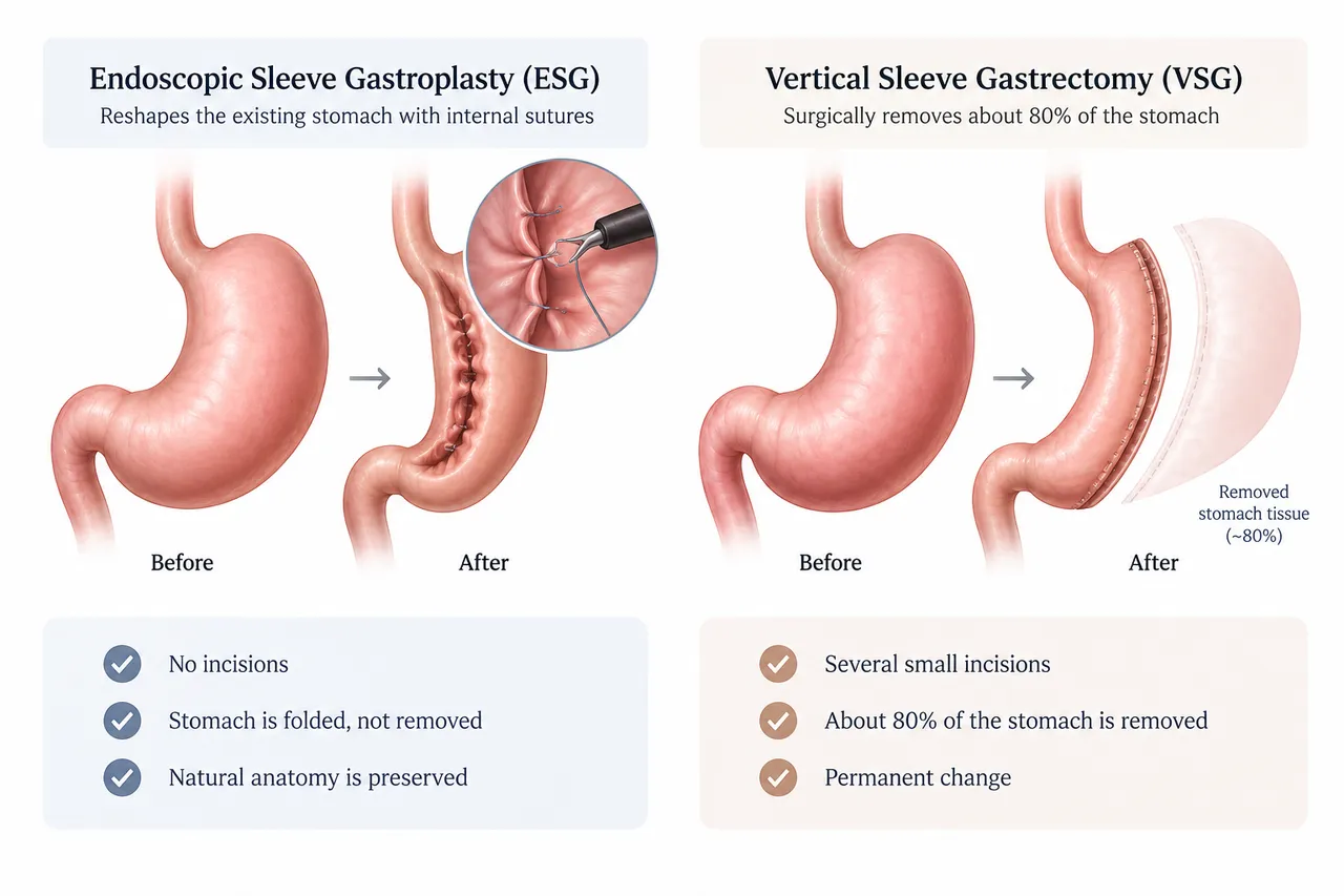 Ilustración comparativa de la gastroplastia endoscópica en manga y la anatomía de la manga gástrica quirúrgica