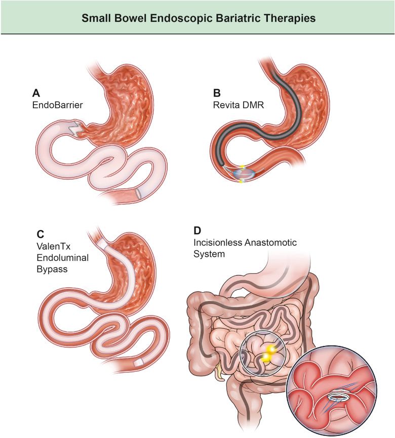 Small bowel endoscopic bariatric therapies