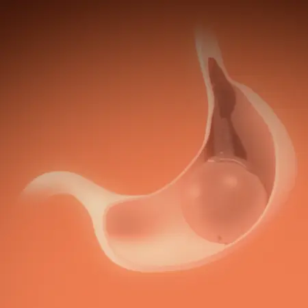 Gastric Balloon
