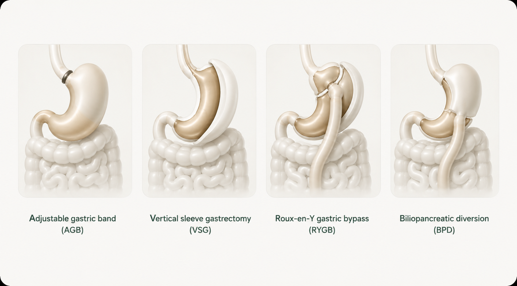 Imagen ilustrativa para liposuction vs bariatric surgery