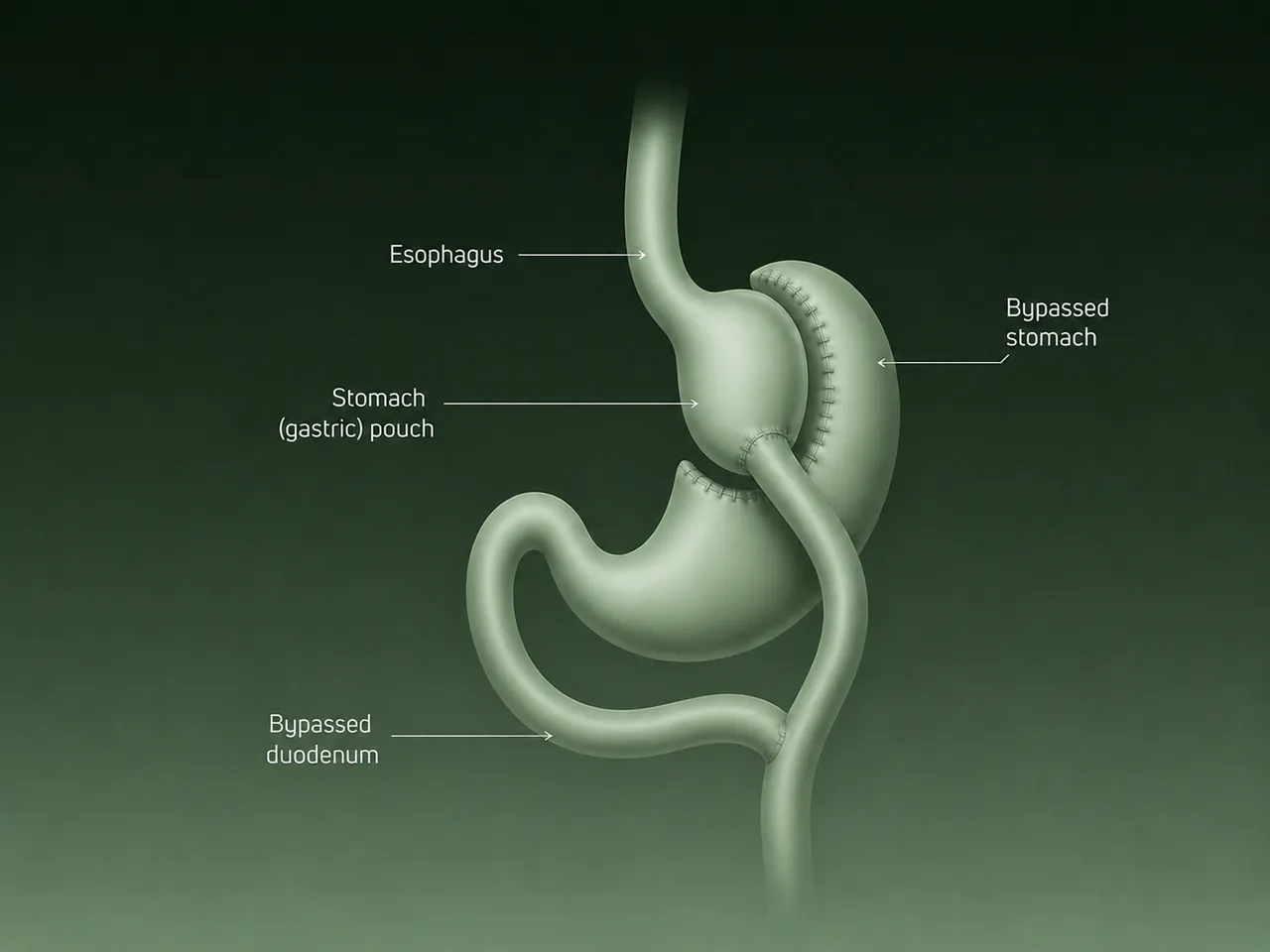 Imagen ilustrativa para liposuction vs bariatric surgery
