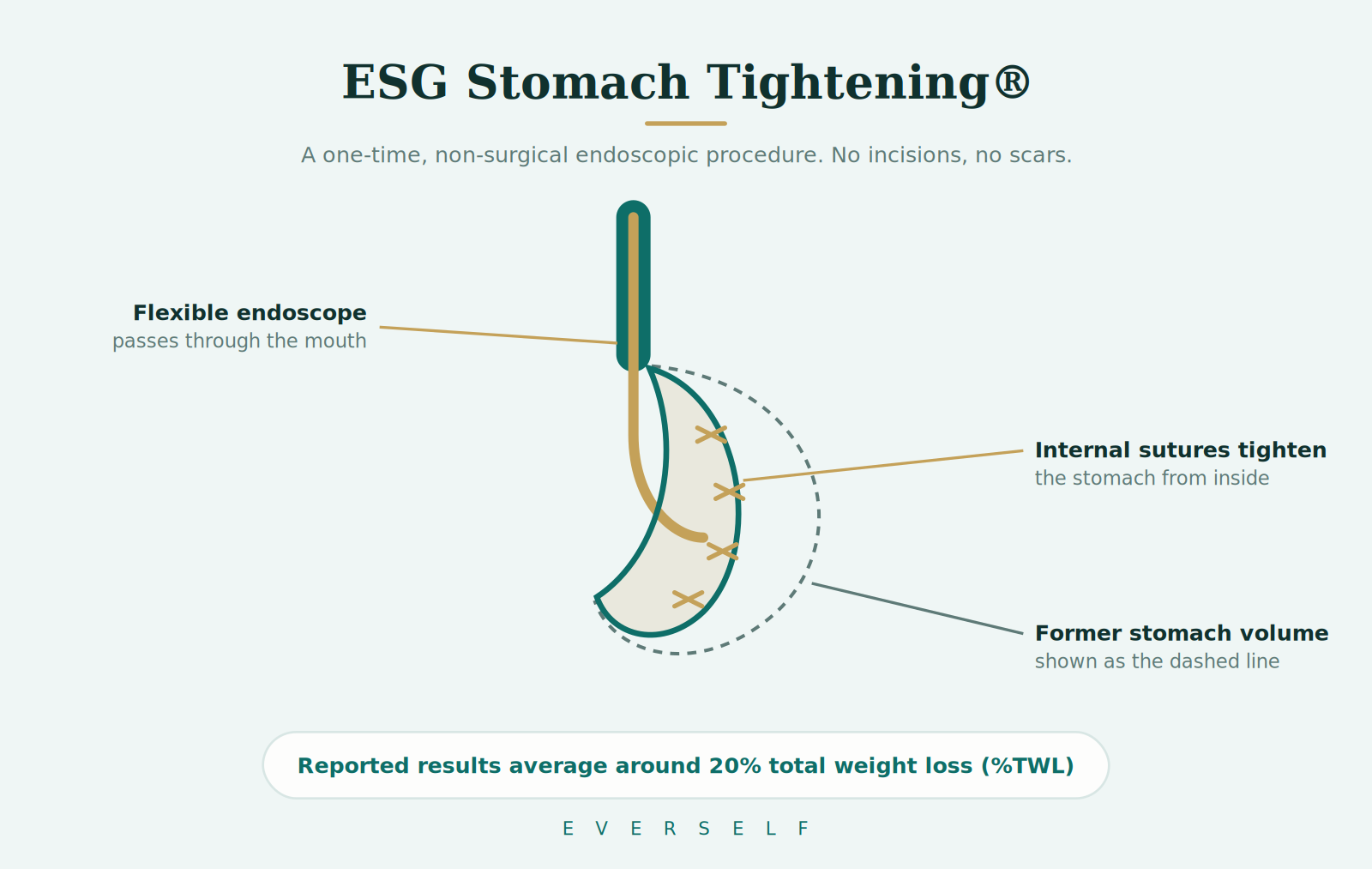Illustration of an endoscopic suturing device tightening the stomach from the inside