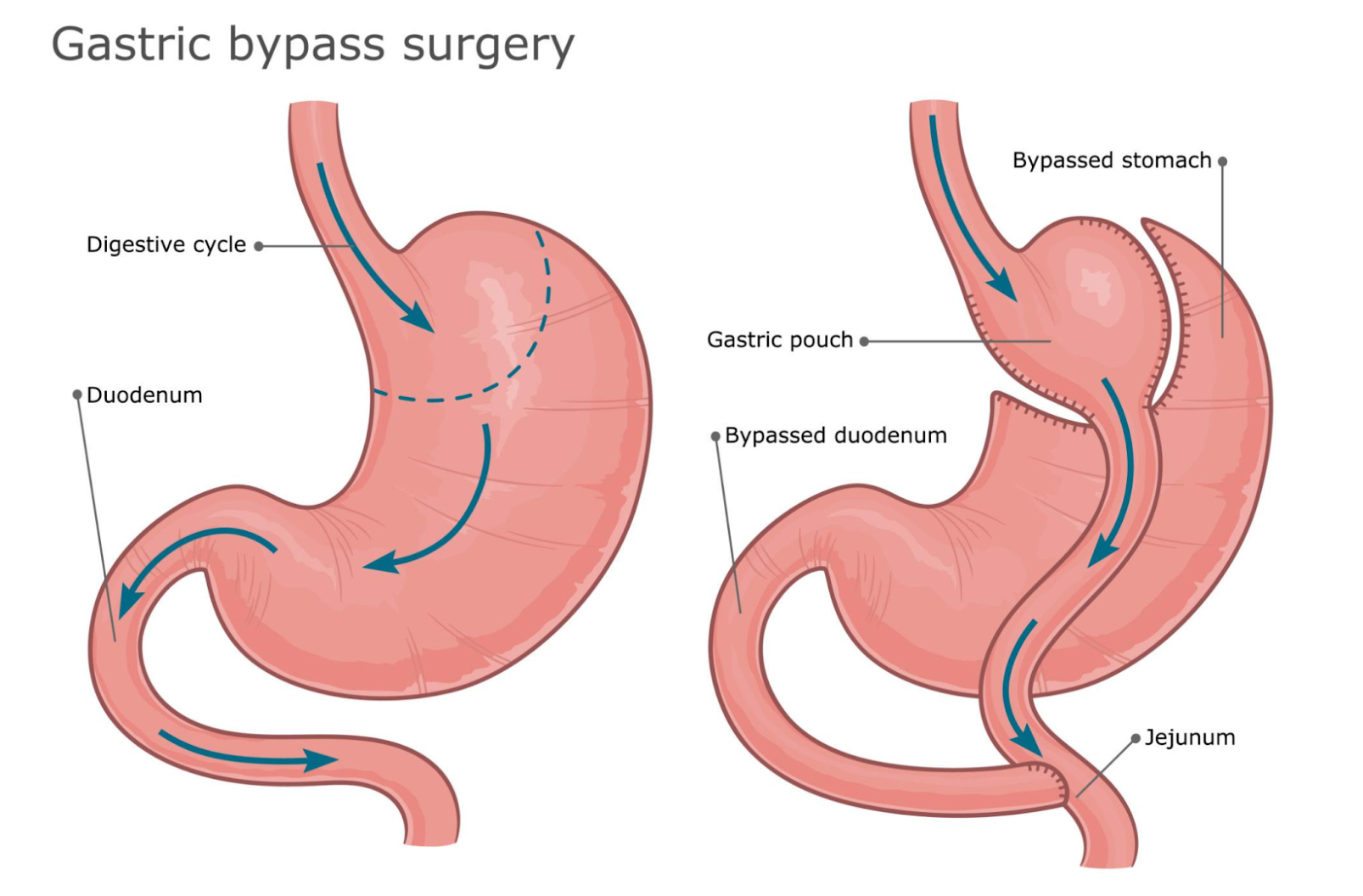 Anatomical diagram comparing a normal stomach with gastric bypass surgery, showing the gastric pouch, bypassed stomach, and rerouted small intestine