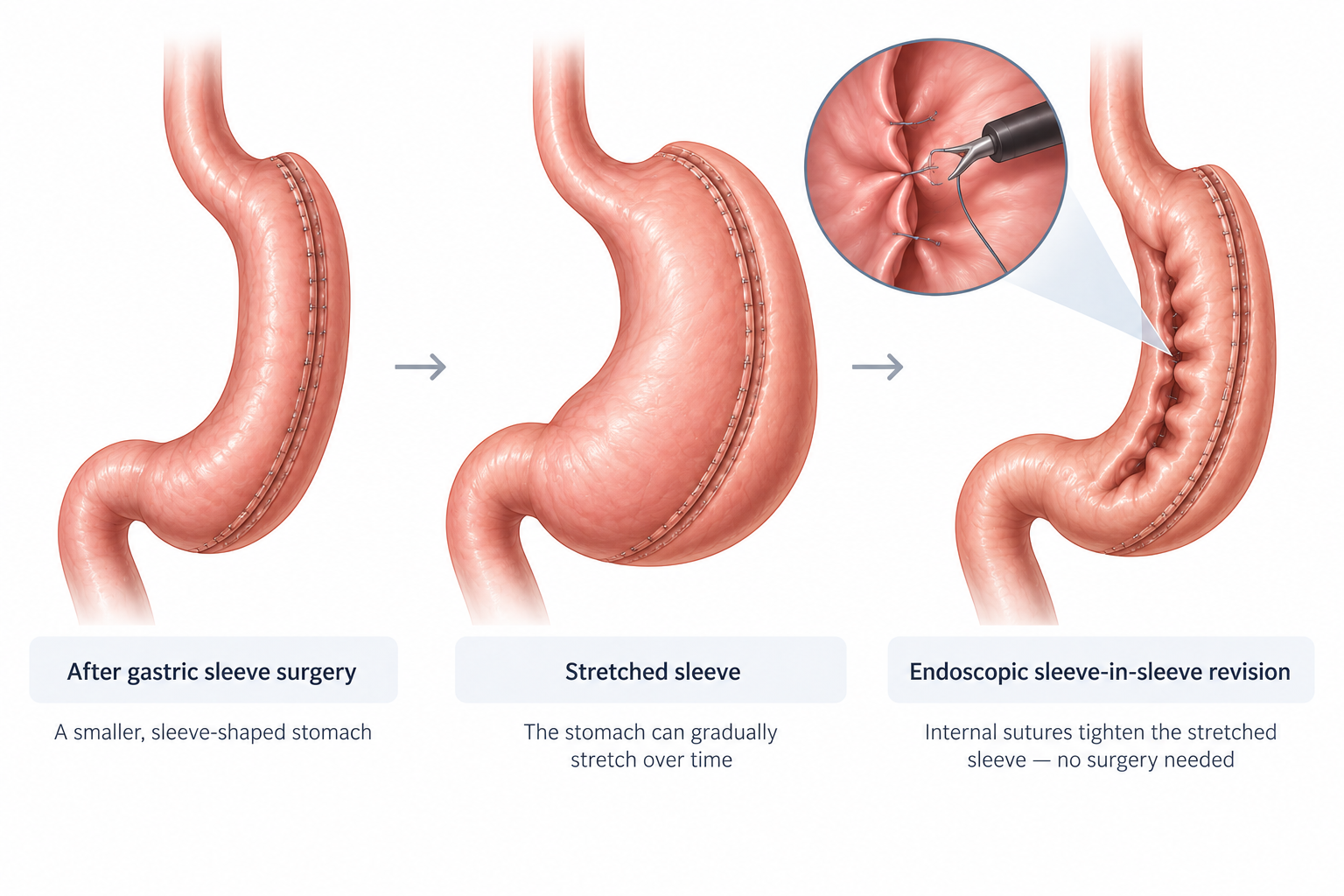 Illustration showing endoscopic sleeve-in-sleeve revision tightening a stretched gastric sleeve