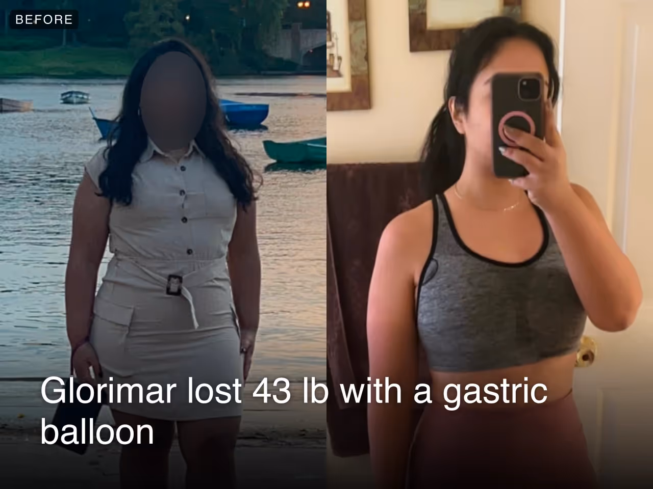 Before and after images of Glorimar who lost 43 pounds with a gastric balloon procedure