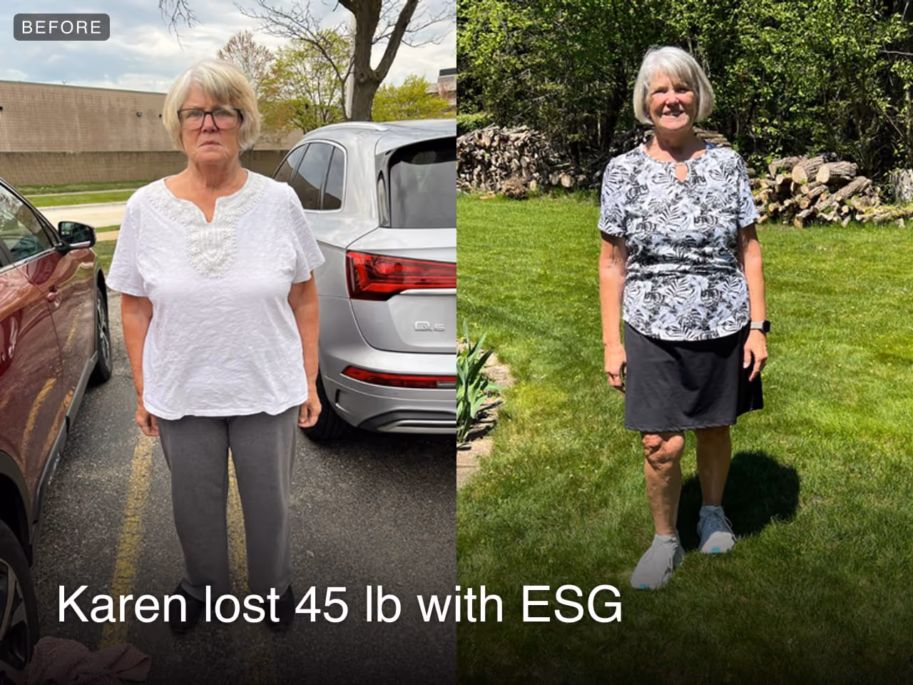 Before and after image of Karen who lost 45 lbs in 1 year with ESG