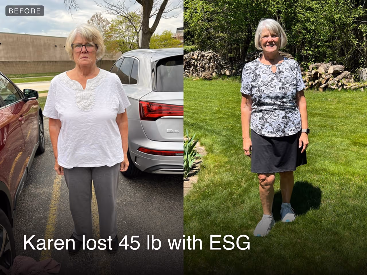 Before and after image of Karen who lost 45 lbs in 1 year with ESG