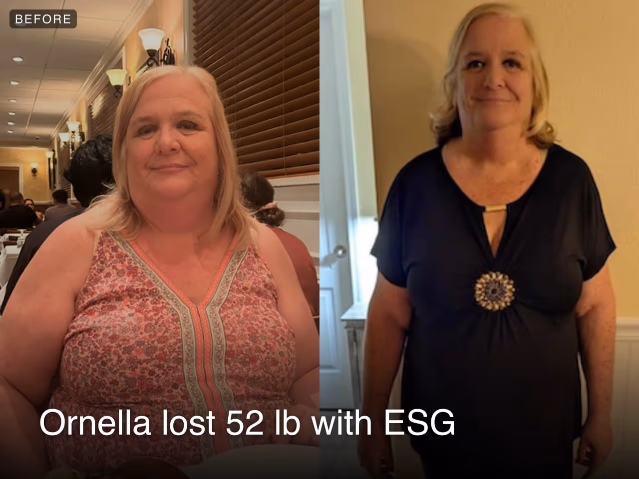 Before and after image of Ornella who lost 52 lbs in 5 months with ESG