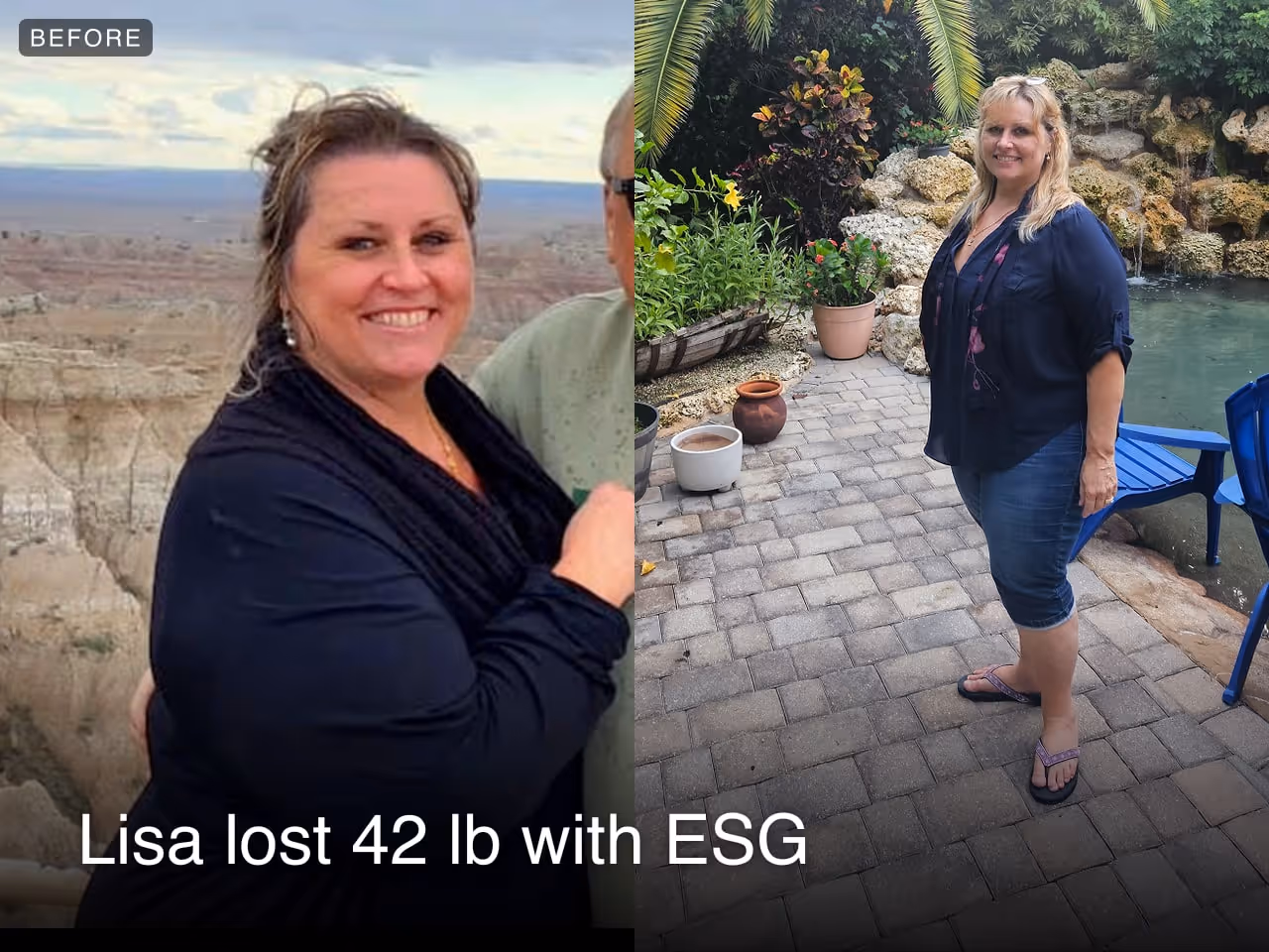 Before and after images of Lisa who lost 42 pounds in 3 months after an ESG procedure