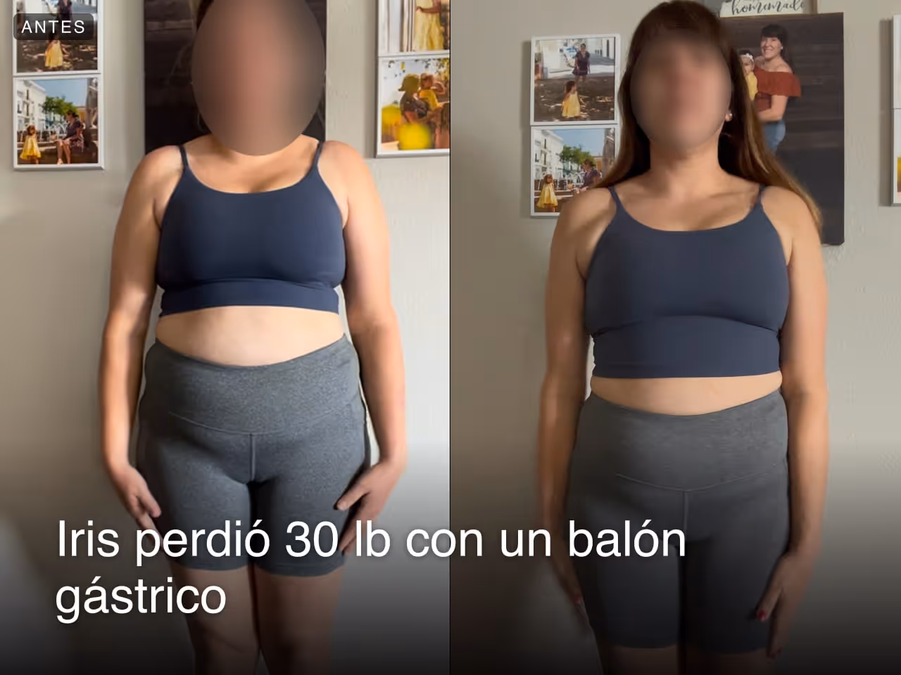 Imágenes de antes y después de Iris, quien perdió 30 libras en 4 meses después de un procedimiento de Balón Gástrico con Everself