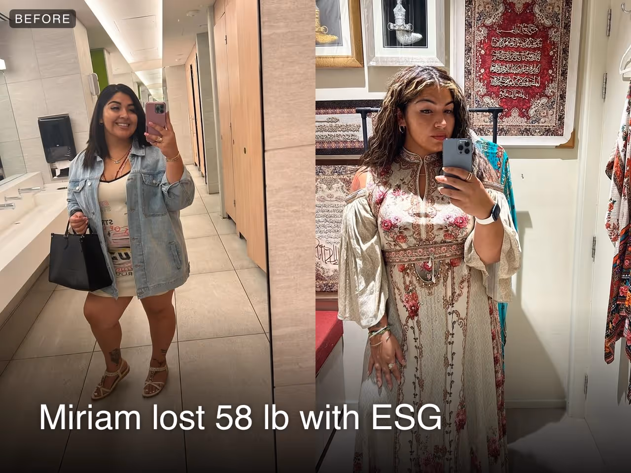 Before and after images of Miriam who lost 58 pounds with an ESG procedure