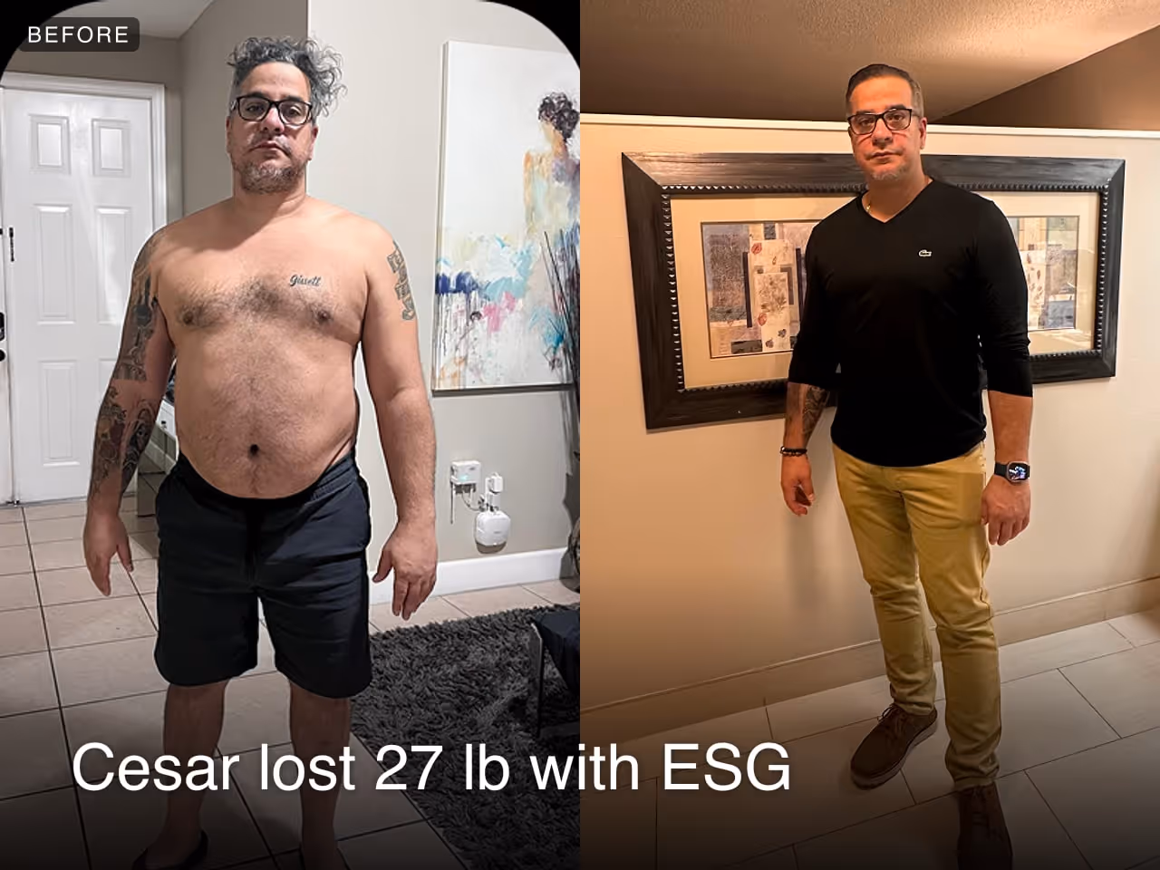 Before and after images of Cesar who lost 27 pounds in 1 month through Everself's ESG Stomach Tightening® procedure