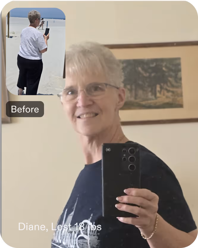 Diane lost 18 lbs with a TORe revision procedure with Everself