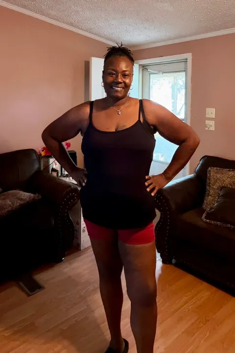 Krystal after ESG Stomach Tightening