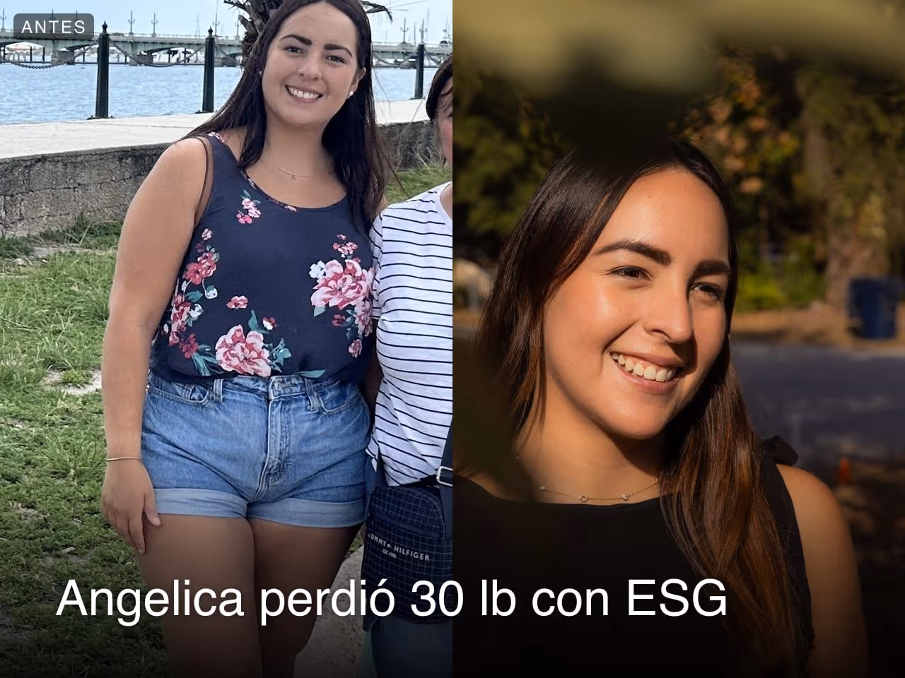 Imágenes de antes y después de Angélica, quien perdió 30 libras en 3 meses después de un procedimiento ESG con Everself