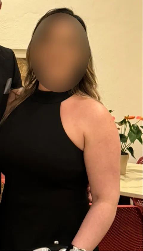 Natalie before ESG Stomach Tightening