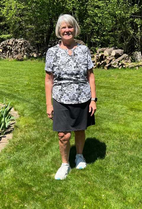 Karen after ESG Stomach Tightening