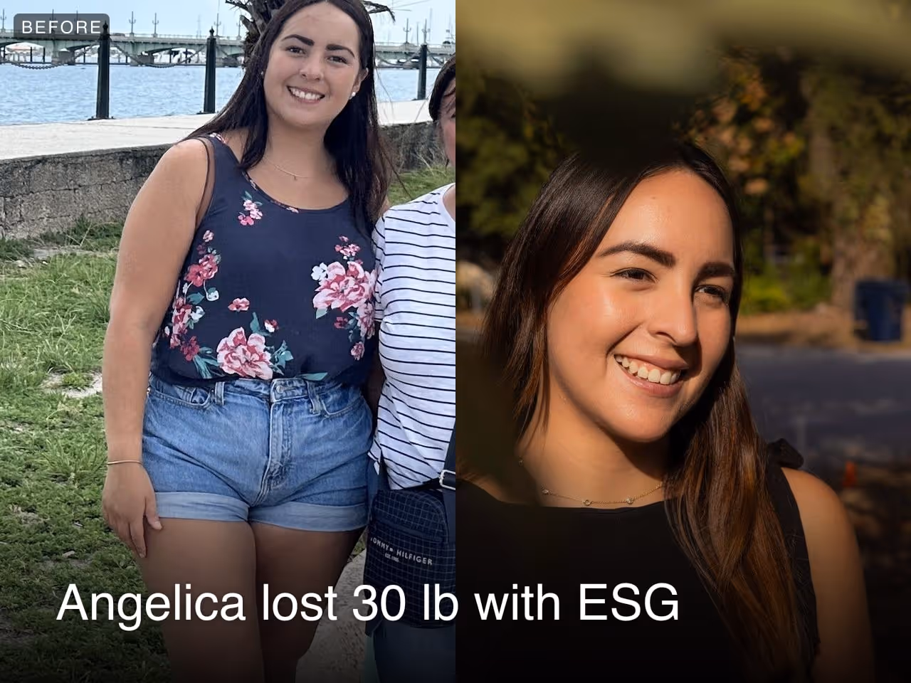 Before and after images of Angelica who lost 30 pounds in 3 months after an ESG procedure with Everself