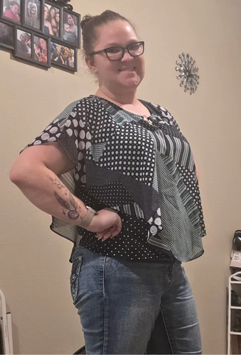 Jaimie after ESG Stomach Tightening