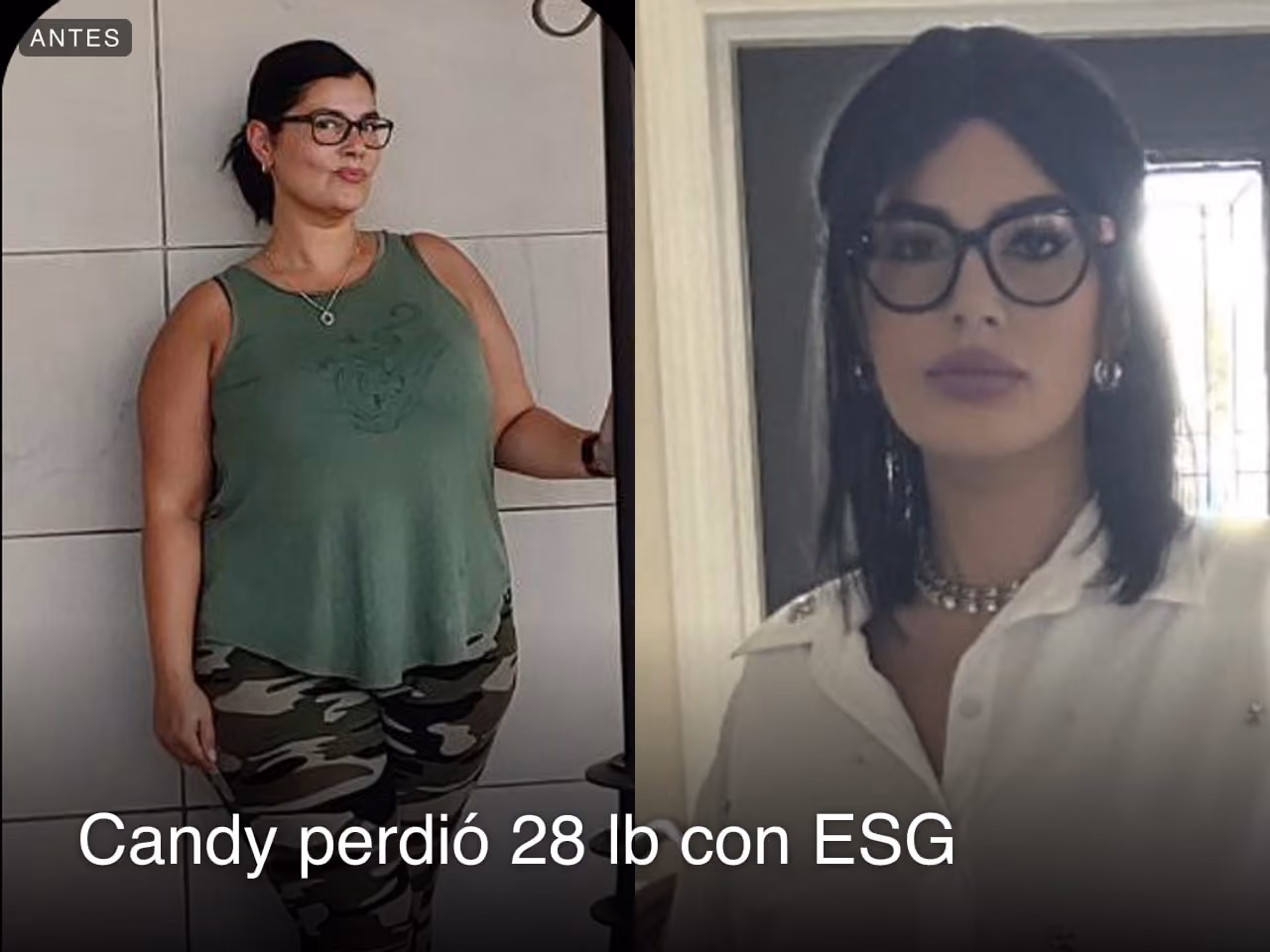 Imágenes de antes y después de Candy, quien perdió 28 libras en 3 meses a través del procedimiento de Reducción de Estómago ESG de Everself.