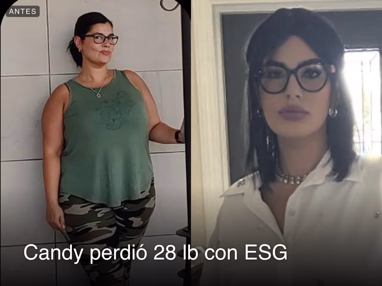 Imágenes de antes y después de Candy, quien perdió 28 libras en 3 meses a través del procedimiento de Reducción de Estómago ESG de Everself.