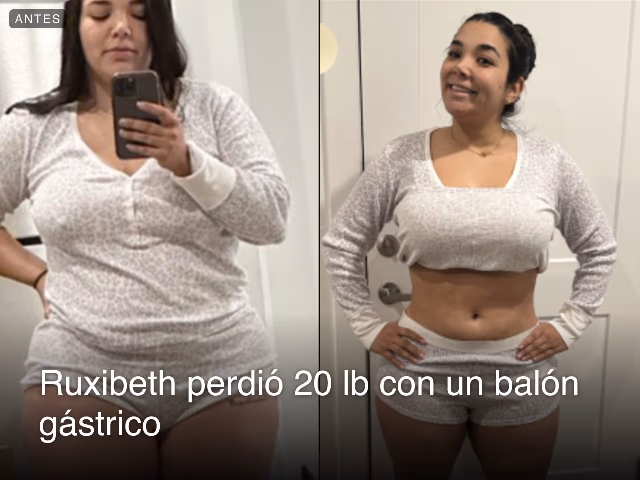 Imagen del antes y después de Ruxibeth que perdió 20 libras en 4 meses con un procedimiento de balón gástrico