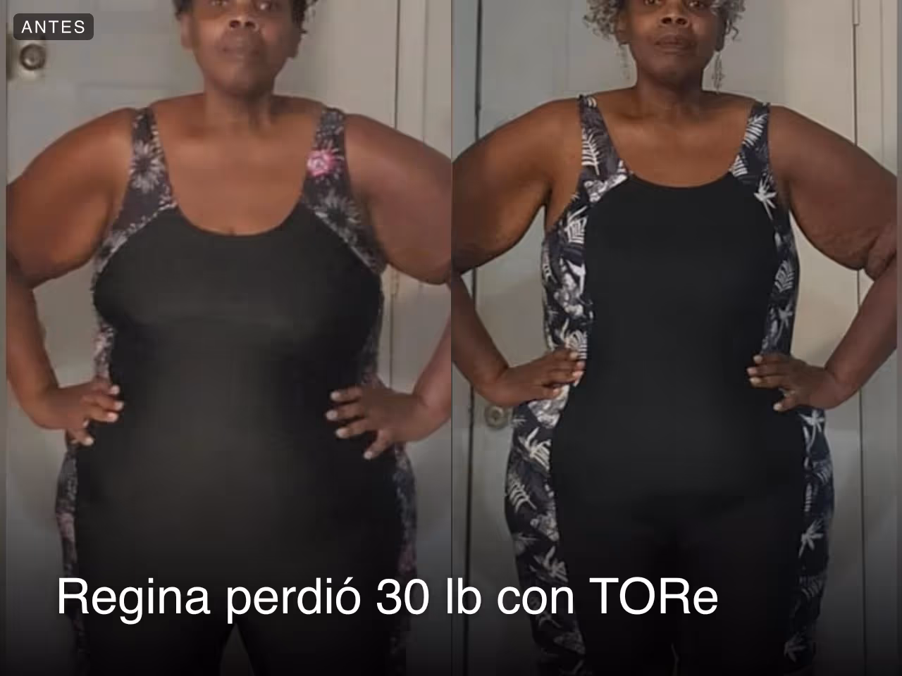 Imágenes de antes y después de Regina que perdió 14 kilos con un procedimiento TORe