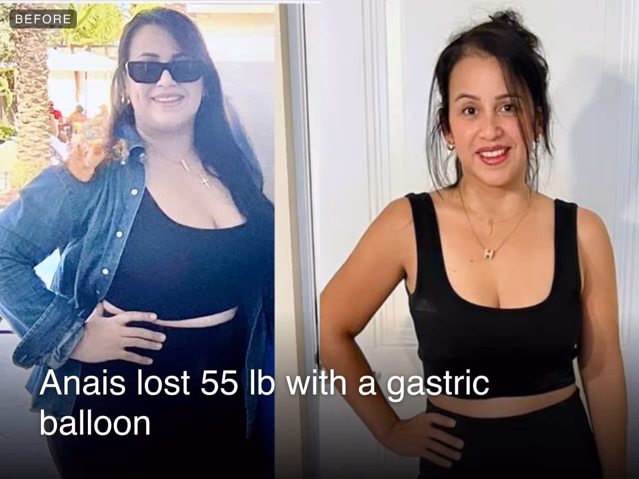 Before and after images of Anais who lost 55 pounds in 6 months after a Gastric Balloon procedure with Everself