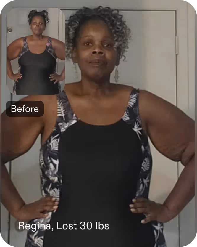 Before and after images of Regina who lost 30 pounds with a TORe procedure