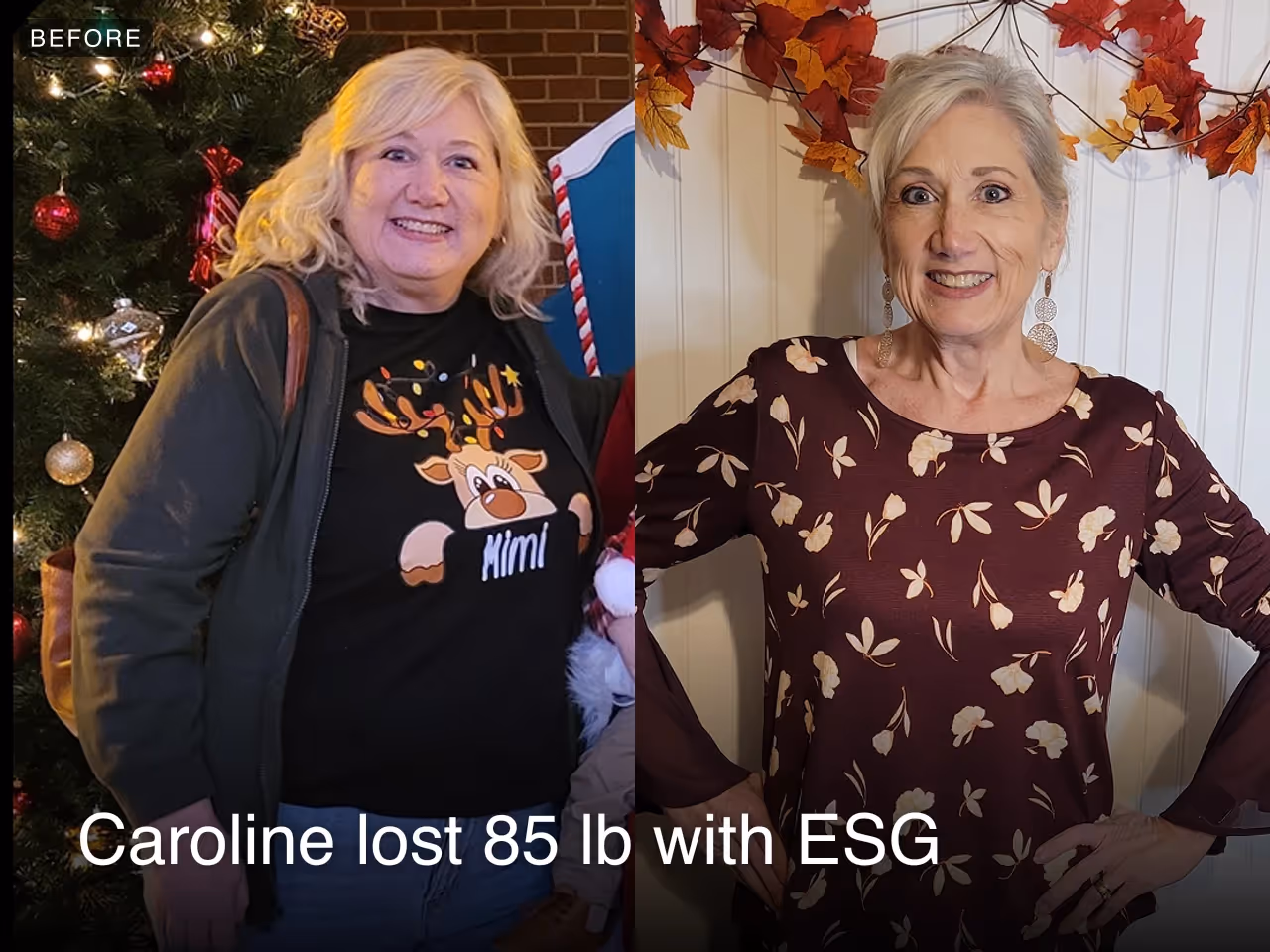 Caroline lost 85 pounds with an ESG from Everself