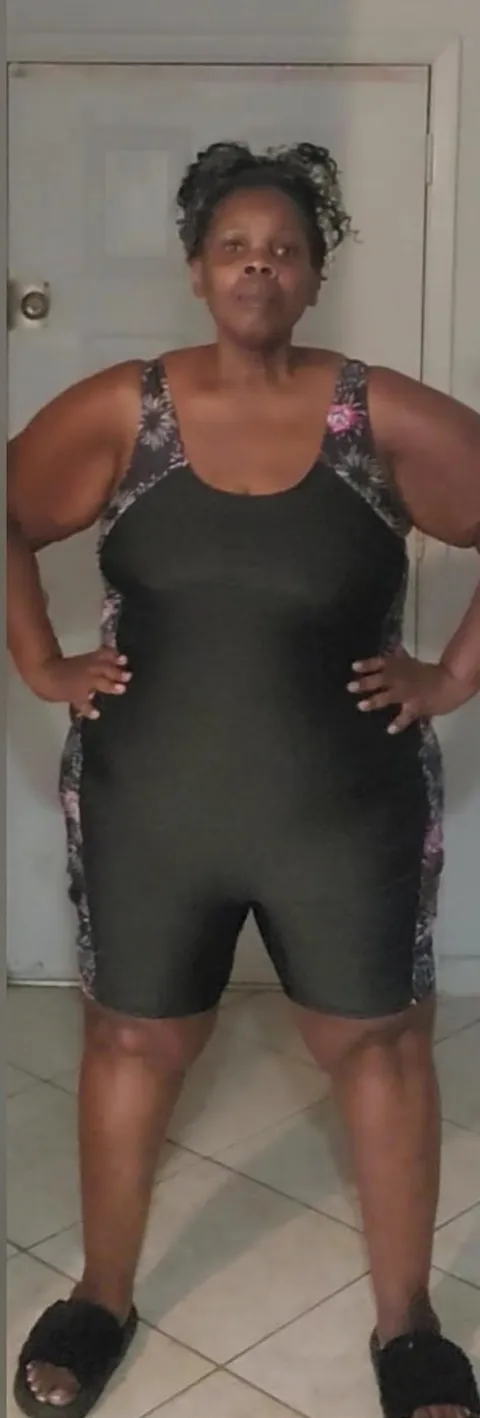 Regina before TORe gastric bypass revision