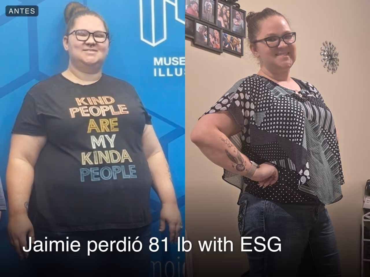 Imagen de antes y después de Jaimie, quien perdió 81 libras en 5 meses con ESG