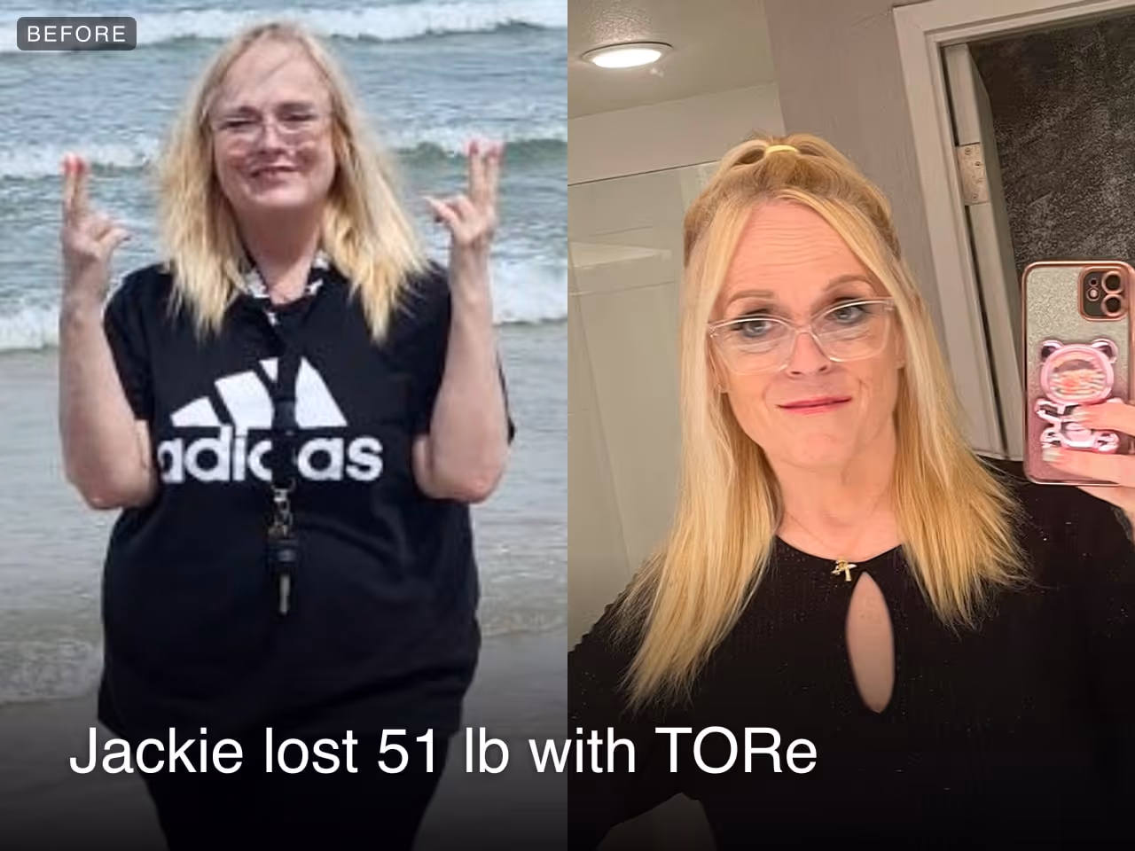Before and after images of Jackie who lost 51 pounds in 5 months after a TORe procedure with Everself