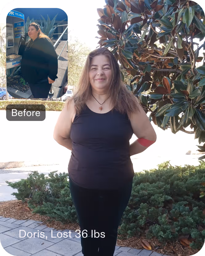 Before and after images of Doris who lost 36 pounds in 5 weeks after a ESG procedure with Everself