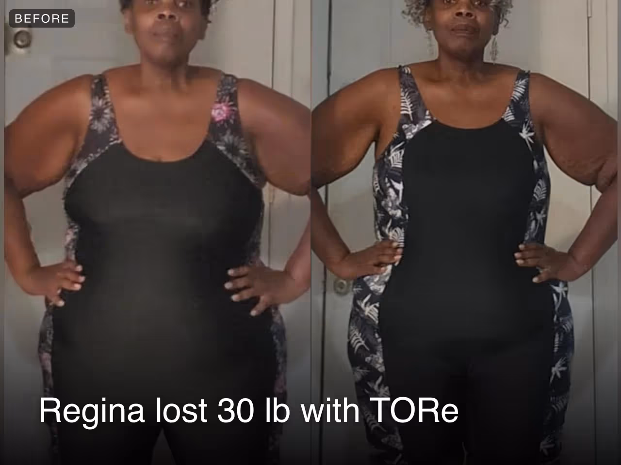Before and after images of Regina who lost 30 pounds with a TORe procedure