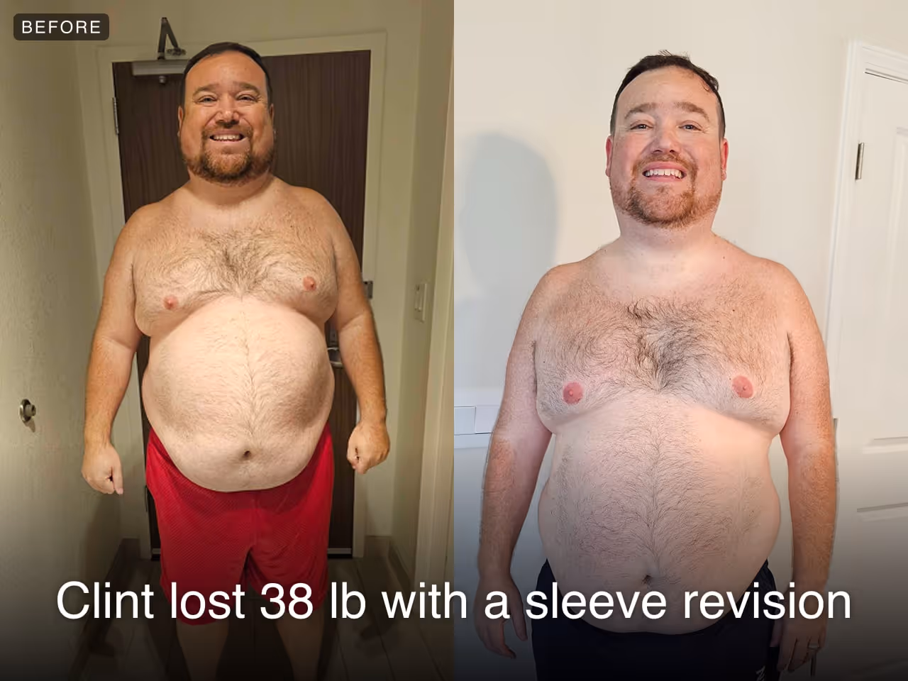 Clint has lost 38 lbs with Everself's revision of sleeve gastrectomy procedure