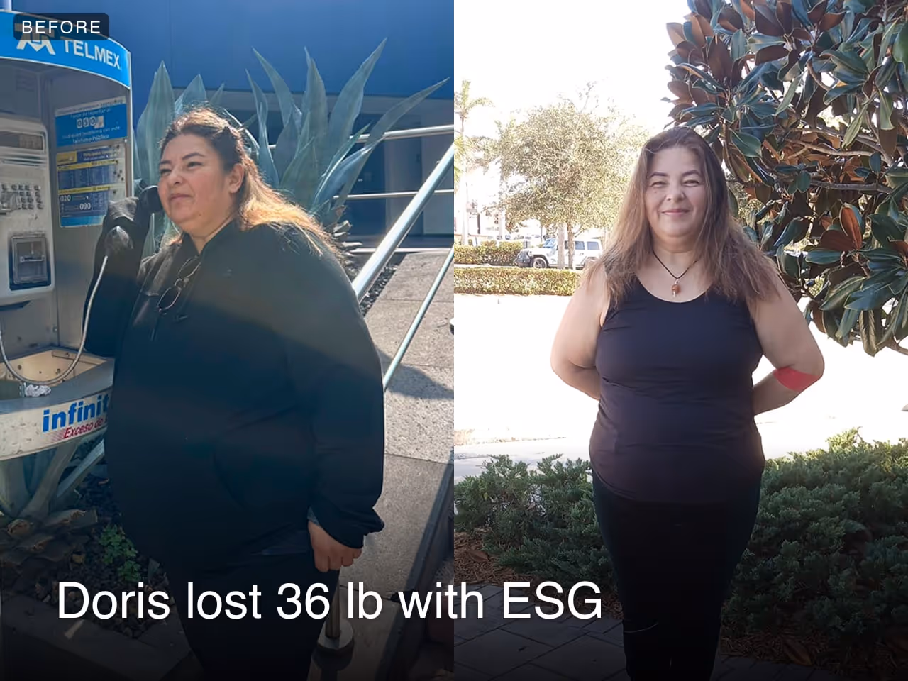 Before and after images of Doris who lost 36 pounds in 5 weeks after a ESG procedure with Everself