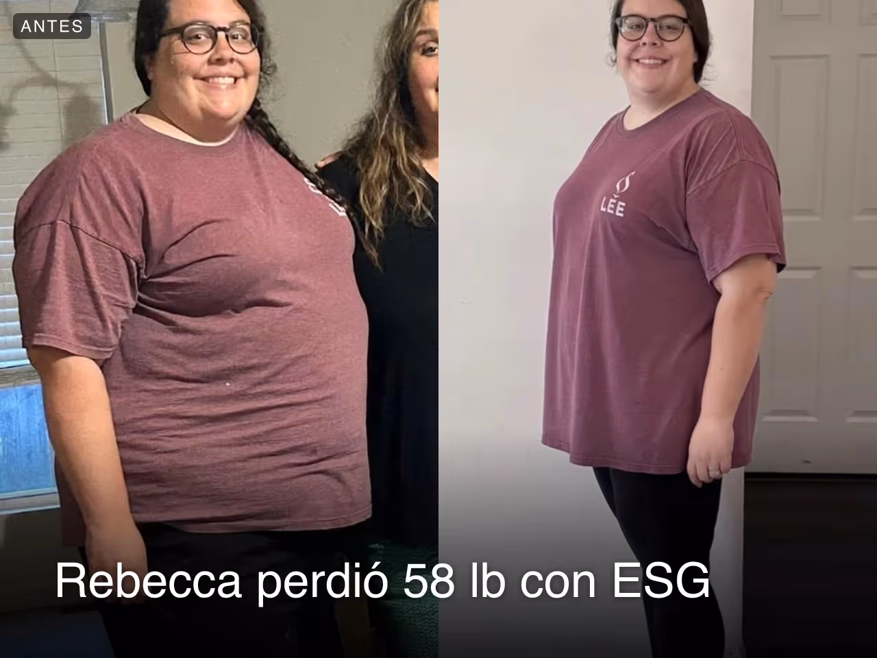 Imágenes de antes y después de Rebecca que perdió 26 kilos con un procedimiento ESG
